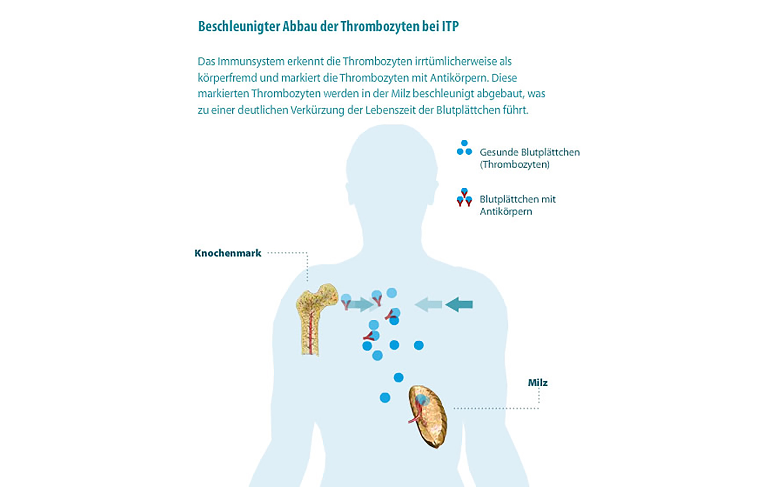 grafik_thrombo_abbau_milz ITP - Abbau in der Milz / Grafik: itp.de